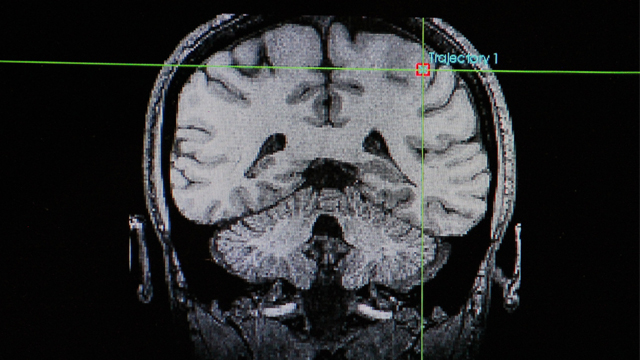 Neuroimaging of the human brain.